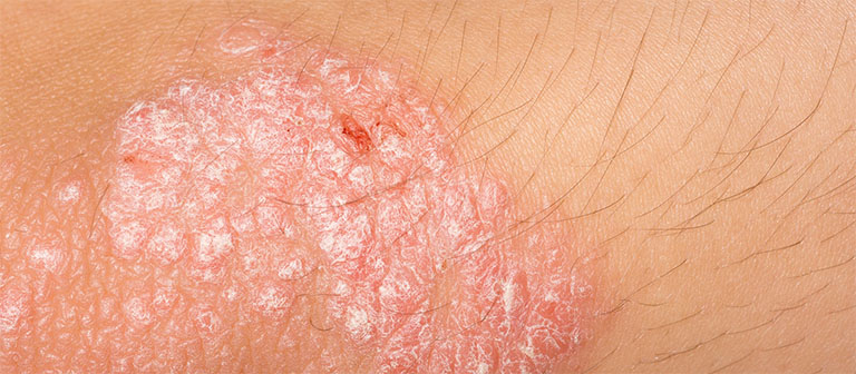 Dương vật bị ngứa